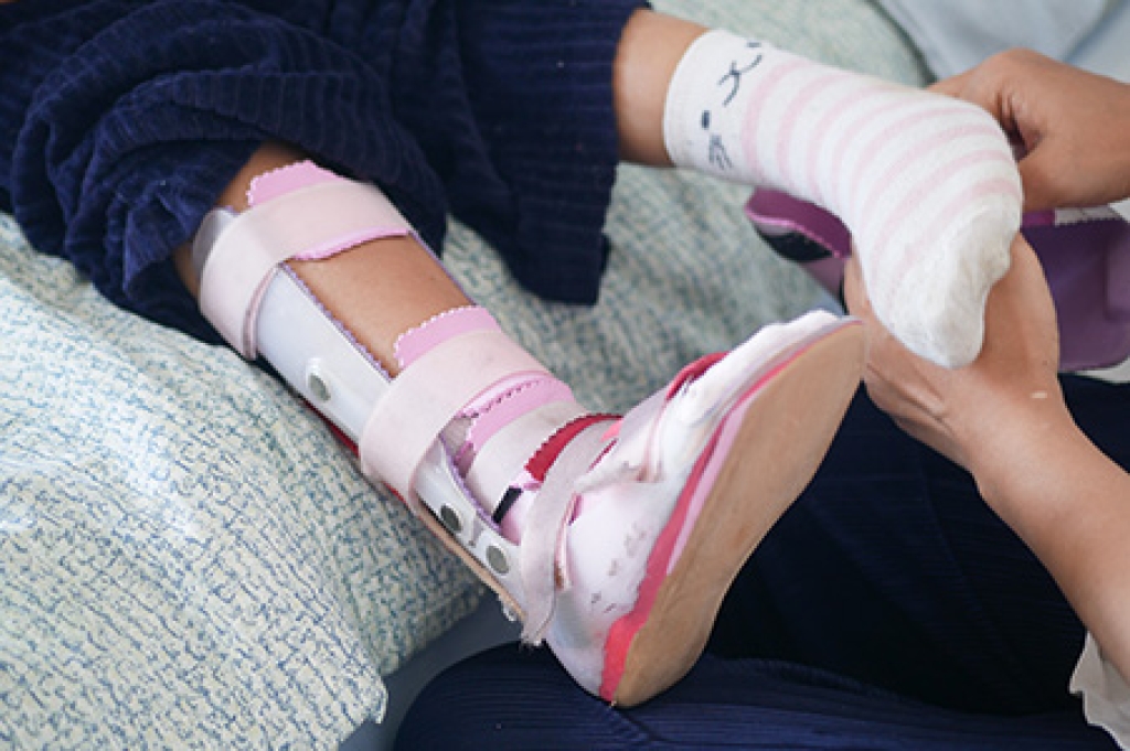 Clubfoot Treatment: Early Care Can Help Your Child Walk with Confidence