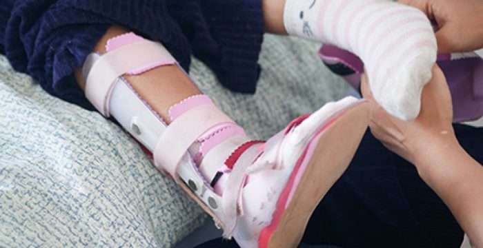 clubfoot-treatment